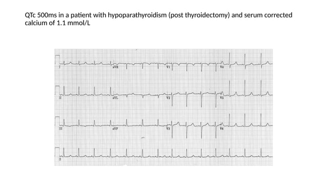 Ekg Changes In Electrolyte Abnormalities Pptx