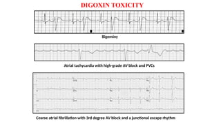 ekg changes in electrolyte abnormalities.pptx