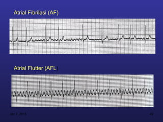 Atrial Fibrilasi (AF)




  Atrial Flutter (AFL)




Jan 7, 2013               49
 