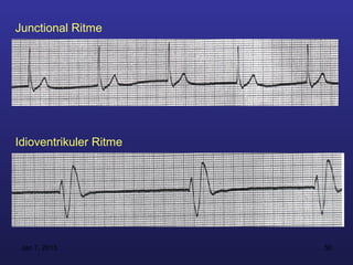 Junctional Ritme




Idioventrikuler Ritme




 Jan 7, 2013            50
 