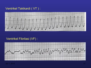 Ventrikel Takikardi ( VT ) :




Ventrikel Fibrilasi (VF) :




Jan 7, 2013                    51
 