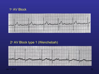 1o AV Block




    2o AV Block type 1 (Wenchebah)




Jan 7, 2013                          52
 