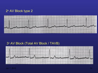 2o AV Block type 2




3o AV Block (Total AV Block / TAVB)




Jan 7, 2013                           53
 