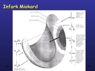 Infark Miokard




Jan 7, 2013      65
 