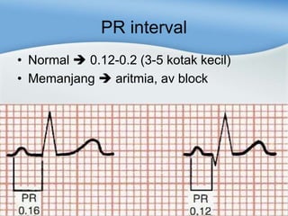PR interval
• Normal 0.12-0.2 (3-5 kotak kecil)
• Memanjang aritmia, av block