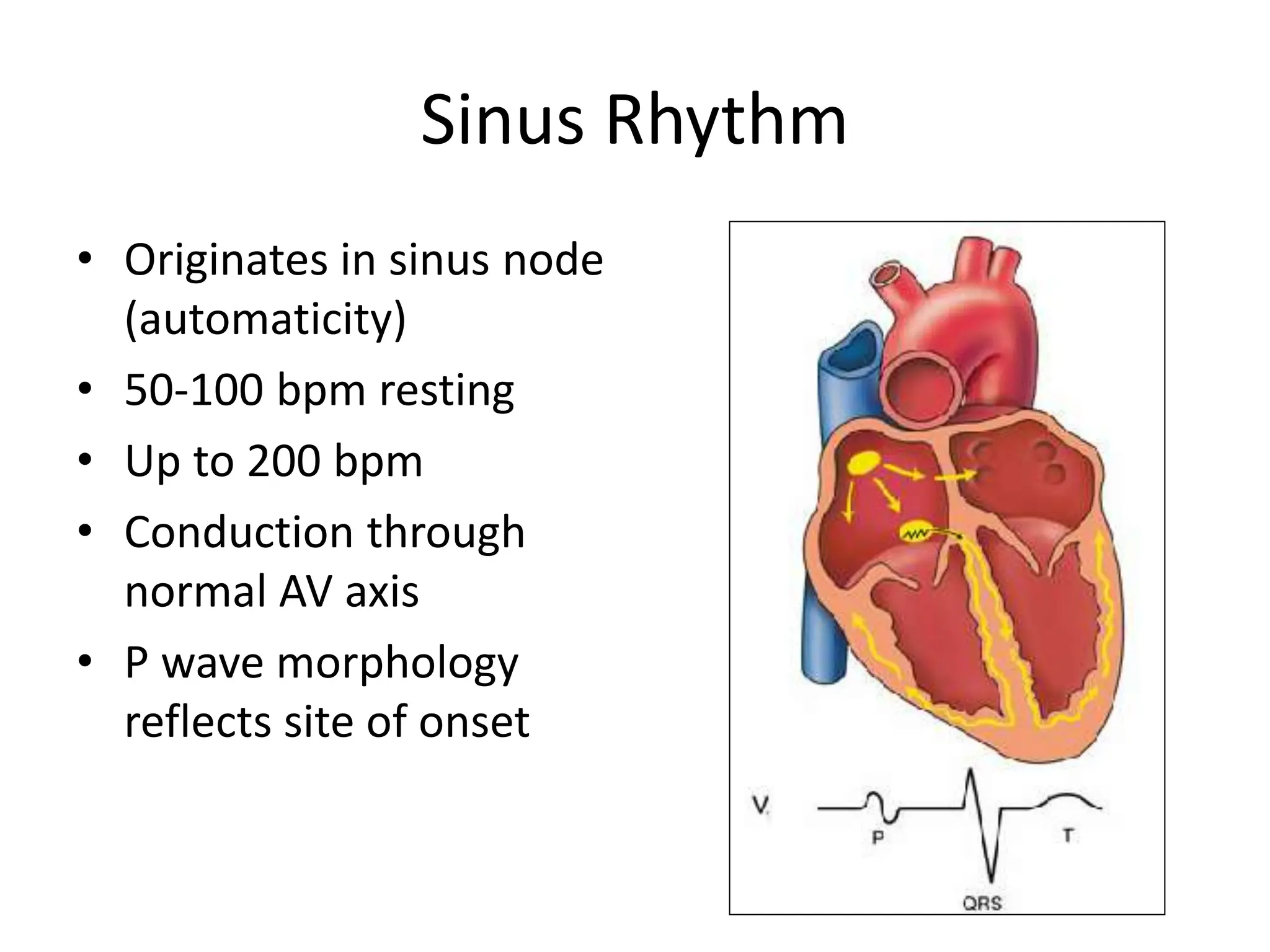 EKG dasar, aritmia SVT, VT, AV block.ppt