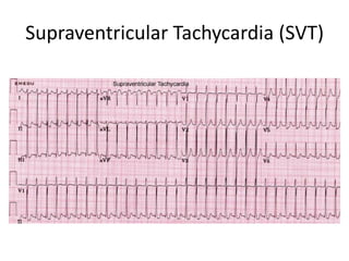 Svt Loop EKG dasar, aritmia SVT, VT, AV block.ppt
