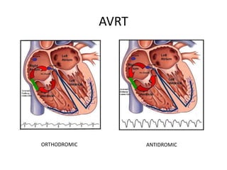 EKG dasar, aritmia SVT, VT, AV block.ppt