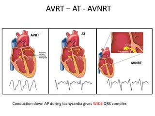 EKG dasar, aritmia SVT, VT, AV block.ppt
