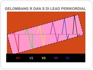 GELOMBANG R DAN S DI LEAD PERIKORDIAL
V1 V2 V3 V4 V5 V6
 