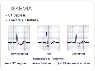 ISKEMIA
 ST depresi
 T inversi ( T terbalik)
 