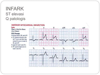 INFARK
ST elevasi
Q patologis
 