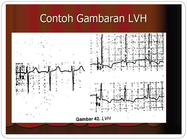 EKG Dasar dan Cara Interpretasi.pptx