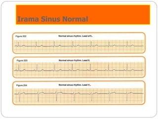 Irama Sinus Normal
 