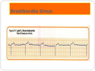 Bradikardia Sinus
 