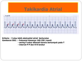 Takikardia Atrial
Kriteria : 3 atau lebih ekstrasitol atrial berturutan
Gambaran EKG : - frekuensi biasanya 160-250 /menit
- sering P sukar dikenali karena bertumpuk pada T
- interval P-P dan R-R teratur
 