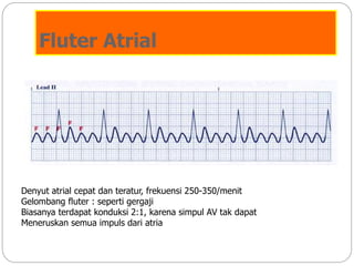 Fluter Atrial
Denyut atrial cepat dan teratur, frekuensi 250-350/menit
Gelombang fluter : seperti gergaji
Biasanya terdapat konduksi 2:1, karena simpul AV tak dapat
Meneruskan semua impuls dari atria
 