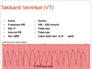 Takikardi Ventrikel (VT)
 Irama : Teratur
 Frekwensi HR : 100 – 250 x/menit
 Gel. P : Tidak ada
 Interval PR : Tidak ada
 Gel. QRS : Lebar lebih dari 0,12 detik
 