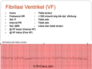 Fibrilasi Ventrikel (VF)
 Irama : Tidak teratur
 Frekwensi HR : < 350 x/menit shg tdk dpt dihitung
 Gel. P : Tidak ada
 Interval PR : Tidak ada
 Gel. QRS : Lebar dan tidak teratur
 @ VF kasar (Coarse VF)
 @ VF halus (Fine VF)
 