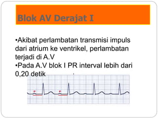 Blok AV Derajat I
•Akibat perlambatan transmisi impuls
dari atrium ke ventrikel, perlambatan
terjadi di A.V
•Pada A.V blok I PR interval lebih dari
0,20 detik
 