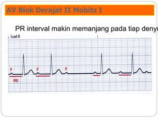AV Blok Derajat II Mobitz I
PR interval makin memanjang pada tiap denyu
 