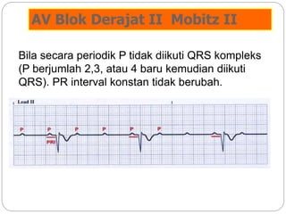 AV Blok Derajat II Mobitz II
Bila secara periodik P tidak diikuti QRS kompleks
(P berjumlah 2,3, atau 4 baru kemudian diikuti
QRS). PR interval konstan tidak berubah.
 