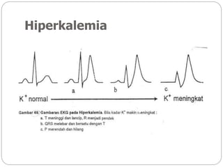 Hiperkalemia
 