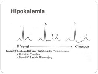 Hipokalemia
 