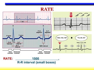 RATE: 1500 .
R-R interval (small boxes)
RATE
 