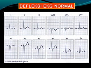 DEFLEKSI EKG NORMAL
 