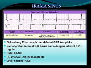 Gelombang P harus ada mendahului QRS kompleks
Irama teratur, interval R-R harus sama dengan interval P-P :
regular
Rate: 60-100
PR interval: .12-.20 (constant)
QRS: normal (<.12)
 
