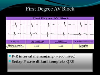 First Degree AV Block
P-R interval memanjang (> 200 msec)
Setiap P wave diikuti kompleks QRS
 