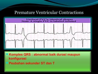 Premature Ventricular Contractions
Komples QRS : abnormal baik durasi maupun
konfigurasi
Peubahan sekunder ST dan T
 