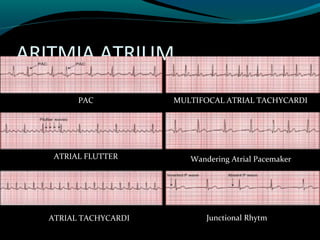 ARITMIA ATRIUM
PAC
ATRIAL FLUTTER
ATRIAL TACHYCARDI
MULTIFOCAL ATRIAL TACHYCARDI
Wandering Atrial Pacemaker
Junctional Rhytm
 