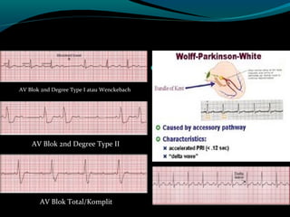 
AV Blok 2nd Degree Type I atau Wenckebach
AV Blok 2nd Degree Type II
AV Blok Total/Komplit
 