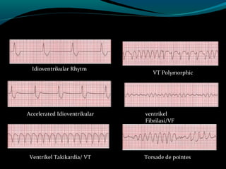 Idioventrikular Rhytm
Accelerated Idioventrikular
Ventrikel Takikardia/ VT
VT Polymorphic
ventrikel
Fibrilasi/VF
Torsade de pointes
 
