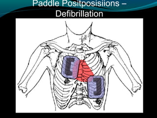 Paddle Positposisiions –
Defibrillation
 