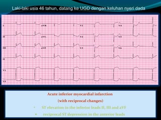 Laki-laki usia 46 tahun, datang ke UGD dengan keluhan nyeri dada
Acute inferior myocardial infarction
(with reciprocal changes)
• ST elevation in the inferior leads II, III and aVF
• reciprocal ST depression in the anterior leads
 