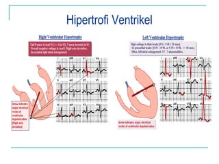 Hipertrofi Ventrikel
 