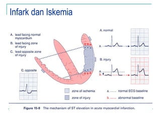 Infark dan Iskemia
 