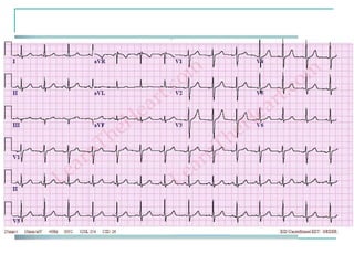 EKG