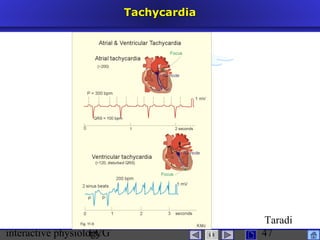 interactive physiologyECG
Taradi
47
TachycardiaTachycardia
 