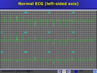 interactive physiologyECG
Taradi
59
Normal ECG (left-sided axis)Normal ECG (left-sided axis)
 