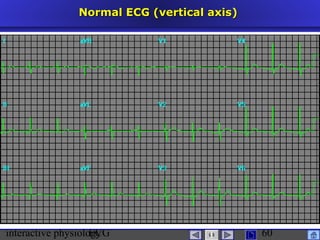 interactive physiologyECG
Taradi
60
Normal ECG (vertical axis)Normal ECG (vertical axis)
 