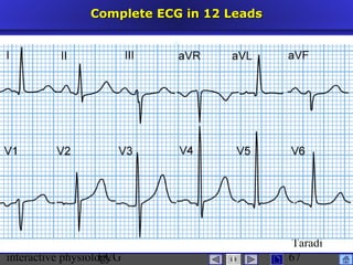 interactive physiologyECG
Taradi
67
Complete ECG in 12 LeadsComplete ECG in 12 Leads
 
