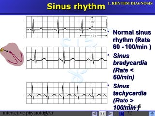 interactive physiologyECG
Taradi
72
Sinus rhythmSinus rhythm
 Normal sinusNormal sinus
rhythm (Raterhythm (Rate
60 - 100/min )60 - 100/min )
 SinusSinus
bradycardiabradycardia
(Rate <(Rate <
60/min)60/min)
 SinusSinus
tachycardiatachycardia
(Rate >(Rate >
100/min100/min ))
1.1. RHYTHM DIAGNOSISRHYTHM DIAGNOSIS
 