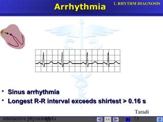 interactive physiologyECG
Taradi
73
ArrhythmiaArrhythmia
 Sinus arrhythmiaSinus arrhythmia
 Longest R-R interval exceeds shirtest > 0.16 sLongest R-R interval exceeds shirtest > 0.16 s
1.1. RHYTHM DIAGNOSISRHYTHM DIAGNOSIS
 