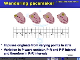 interactive physiologyECG
Taradi
74
Wandering pacemakerWandering pacemaker
 Impuses originate from varying points in atriaImpuses originate from varying points in atria
 Variation in P-wave contour, P-R and P-P intervalVariation in P-wave contour, P-R and P-P interval
and therefore in R-R intervalsand therefore in R-R intervals
1.1. RHYTHM DIAGNOSISRHYTHM DIAGNOSIS
 