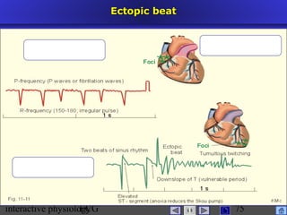 interactive physiologyECG
Taradi
75
Ectopic beatEctopic beat
 