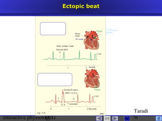 interactive physiologyECG
Taradi
76
Ectopic beatEctopic beat
 